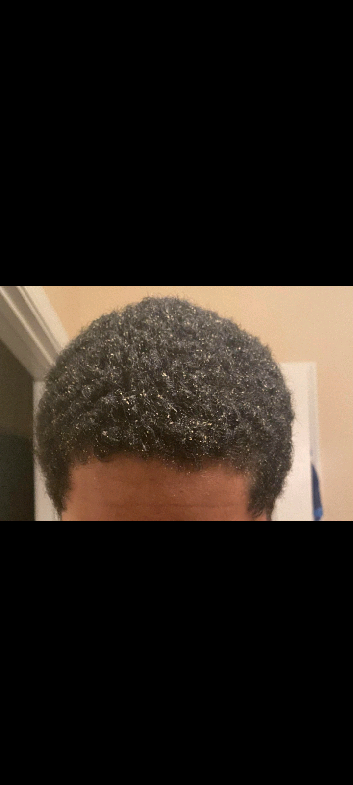Dandruff!!!
